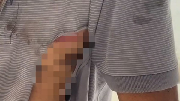 Idoso é agredido com socos e tiro no rosto após reclamar de som alto da casa de vizinho no interior do MA